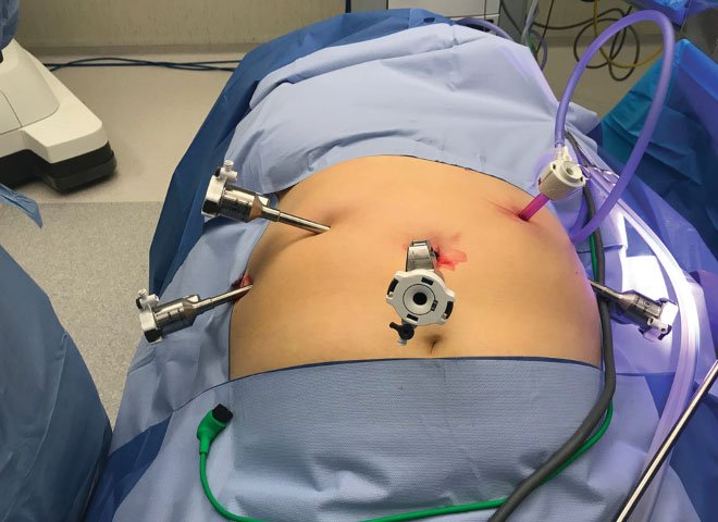Laparoscopic Hiatus Hernia Surgery