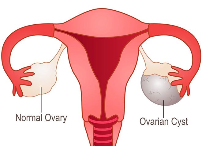 Laparoscopic Ovarian Cyst removal
