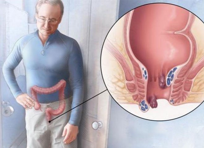 Stapler Haemorrhoidectomy 