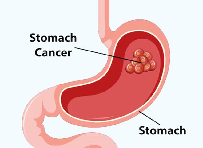 Stomach Cancer