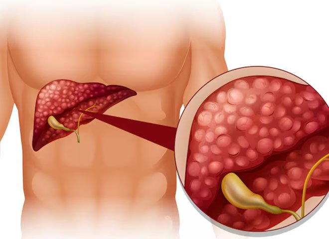 Liver Cirrhosis treatment