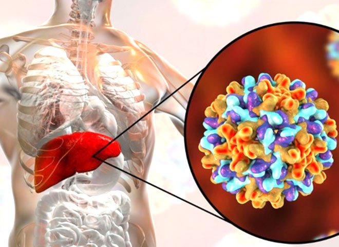 Alcoholic Liver disease