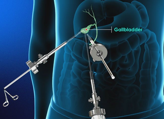 Laparoscopic Gall Bladder Surgery